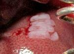 　ラットの肝臓表面に移植したｉＰＳ肝臓（中央の白く見える部分、研究チーム提供）
