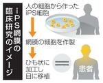 　ｉＰＳ網膜の臨床研究のイメージ