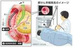 　膵がん早期発見のイメージ