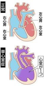 　正常な心臓（上）と「単心室症」の心臓（下）のイメージ