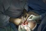 　２０２３年７月１４日、米ニューヨーク大で実施されたブタの腎臓を脳死患者に移植する手術（ＡＰ＝共同）