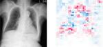 　ぜんそくと診断された胸部エックス線の画像（左）とＡＩの判定図。青色が異常と判定された部分（大阪公立大提供）